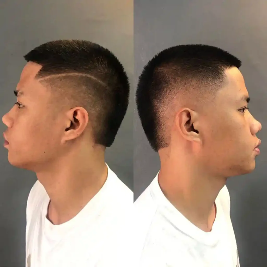 Short Burst Fade Cut with Surgical Part